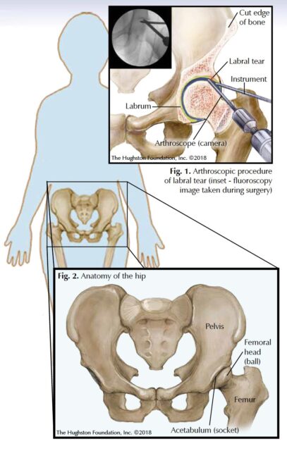 Hip Arthroscopy Florida