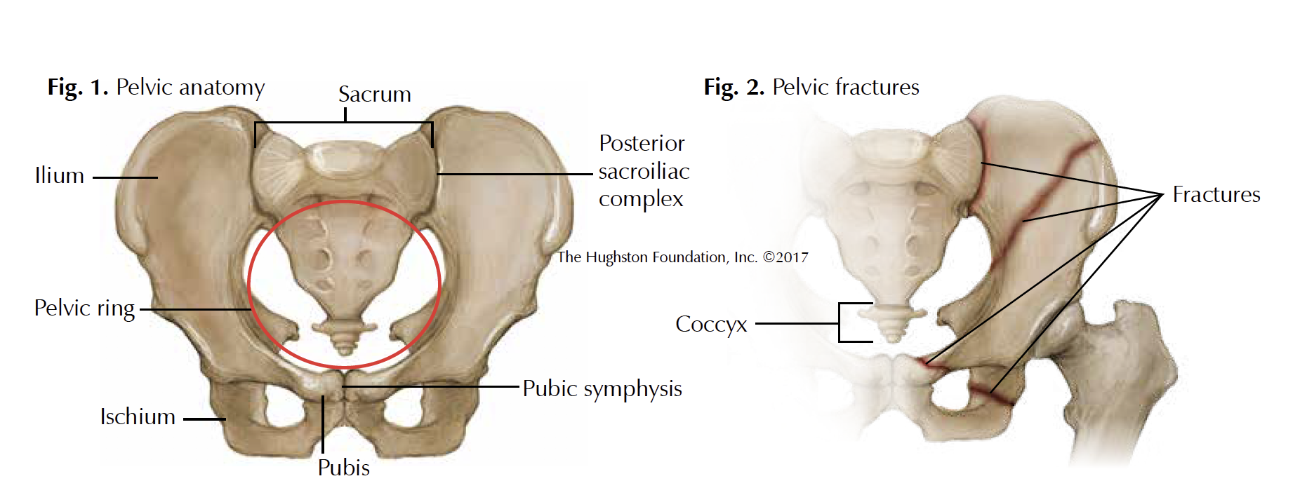 pelvic-fractures-florida