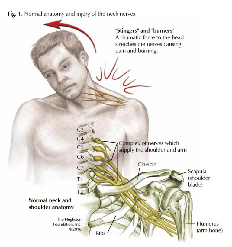 Brachial Plexus Traumatic Nerve Injuries Florida