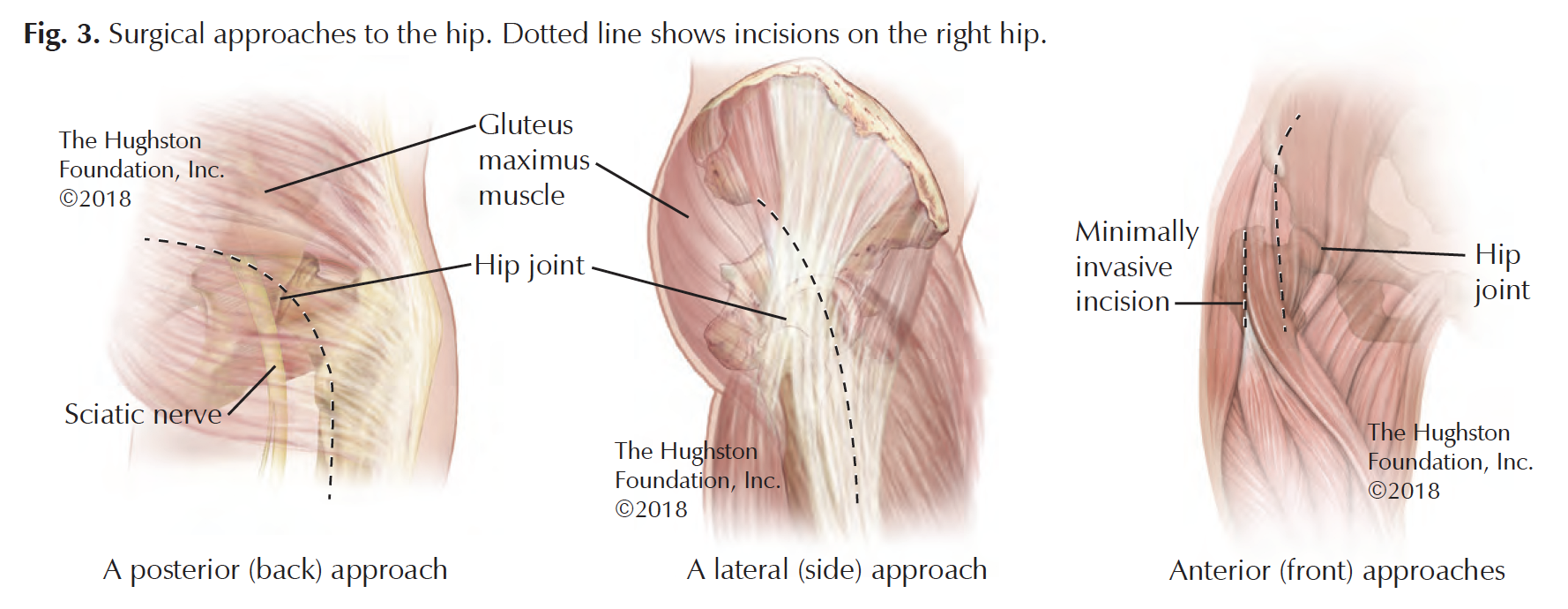 Moore Approach Surgical Approaches to Knee and Hip Replacement - Florida