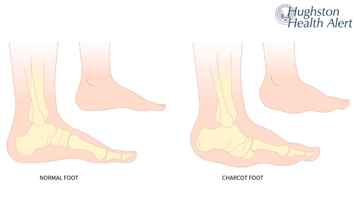 Charcot Joint Disease: A Hidden Consequence of Peripheral Neuropathy